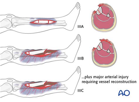 gusilo|Gustilo IIIB Open Tibial Fractures: An Analysis of Infection and ...